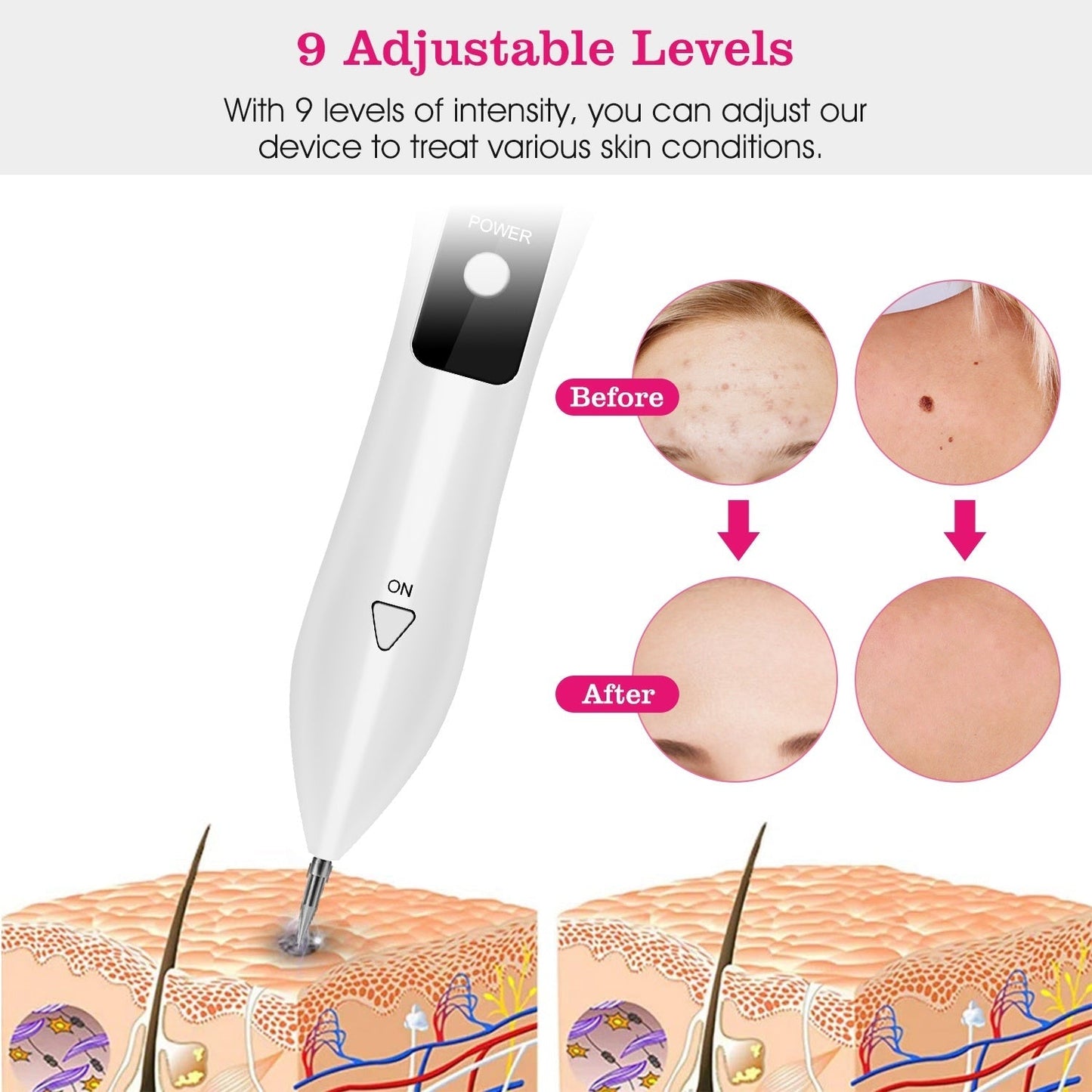 Skin Tag Repair